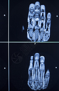 MRI扫描测试结果 手指受伤图片