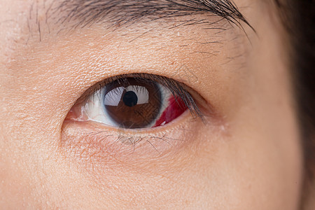 眼睛受伤或因健康概念 大型闭合而被感染病人青光眼白内障发红眼镜红色视网膜镜片健康保险眼科图片