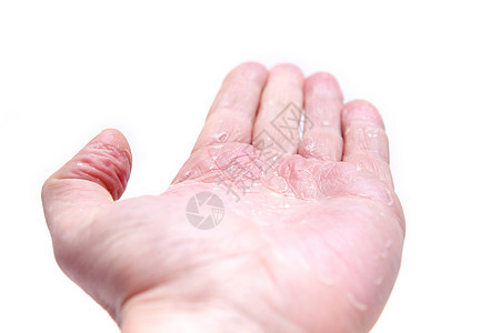 许多人的问题     手头上的湿疹 与众隔绝的背景发痒女孩痛苦身体皮肤药品过敏保健疙瘩皮肤科图片