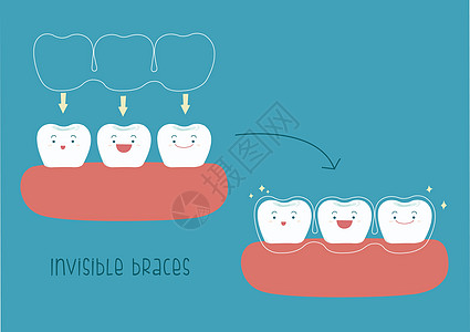 如何用牙齿概念来设置隐形牙套图片