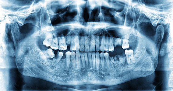 牙齿全景牙科X光图像考试填充管技术诊断药品牙医口服机器电影维修图片