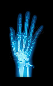 人的手X光图像图片