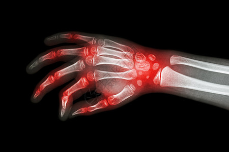 类风湿性关节炎 痛风性关节炎 多关节关节炎患儿的 X 光片手孩子婴儿棕榈痛风外科疾病手指骨骼方阵半径图片