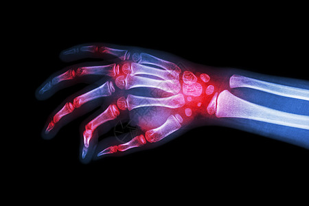 类风湿性关节炎 痛风性关节炎 多关节关节炎患儿的 X 光片手扫描前臂半径风湿指骨手臂手腕创伤腕骨蓝色图片