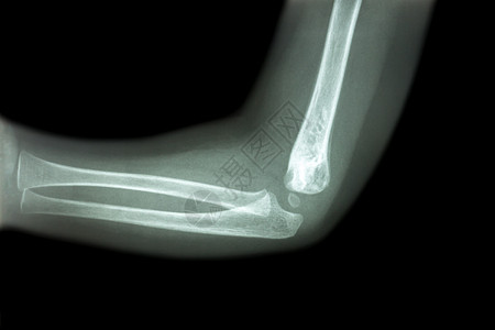 儿童肘部正常儿童肘部X光片侧视 横向扫描x射线前臂骨骼解剖学诊断病人手臂医院外科图片