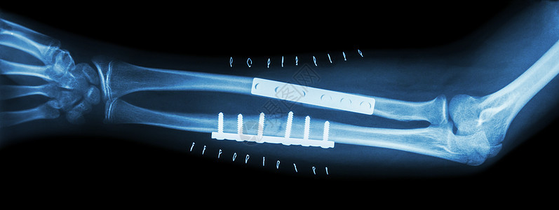 前臂骨折断耳纳尔和半径 由板块和螺丝操纵和内部固定诊断创伤手腕电影病人疾病手臂x射线治疗骨科图片