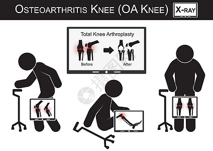 老人膝盖疼痛 监视器显示全膝关节置换术 手术治疗前后 骨关节炎膝关节矢量 平面设计 保健概念 的图像图片
