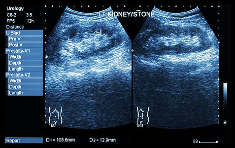 肾的超声波分析 显示左肾结石2张图象比较超声疾病医院检查卫生科学病人石头泌尿放射科图片