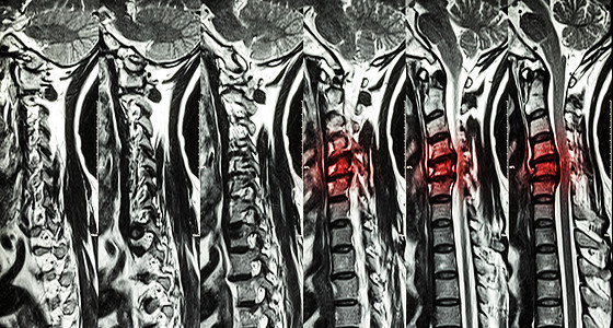 颈椎病伴椎间盘突出症 颈椎MRI 显示颈椎病伴椎间盘突出症压迫脊髓 脊髓病疾病调查放射科药品扫描脊椎绳索保健卫生医生图片