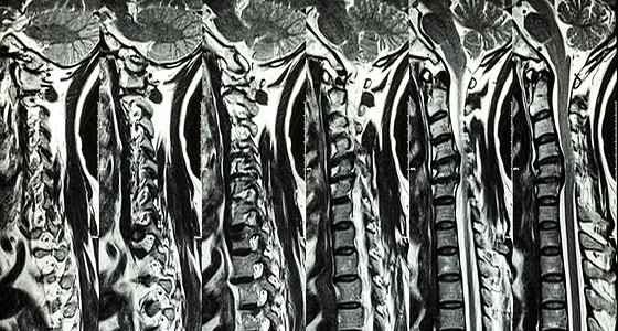 颈椎病伴椎间盘突出症 颈椎MRI 显示颈椎病伴椎间盘突出症压迫脊髓 脊髓病射线x射线病人扫描椎骨医生医院放射科核磁共振骨科背景图片