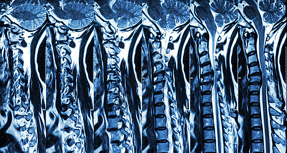 颈椎病伴椎间盘突出症 颈椎MRI 显示颈椎病伴椎间盘突出症压迫脊髓 脊髓病药品医院保健绳索射线病人脊柱脖子谐振x射线图片