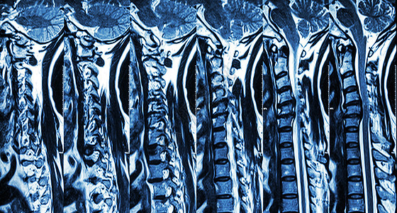 颈椎病伴椎间盘突出症 颈椎MRI 显示颈椎病伴椎间盘突出症压迫脊髓 脊髓病药品医院保健绳索射线病人脊柱脖子谐振x射线图片