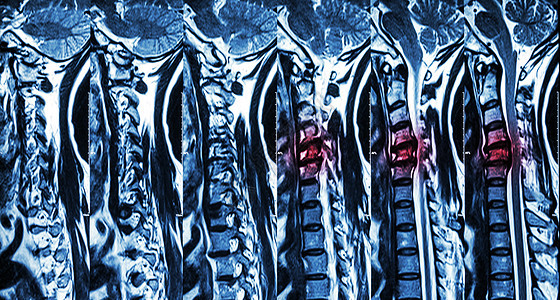 颈椎病伴椎间盘突出症 颈椎MRI 显示颈椎病伴椎间盘突出症压迫脊髓 脊髓病保健药品骨科压缩诊断骨骼x光蓝色x射线疾病图片