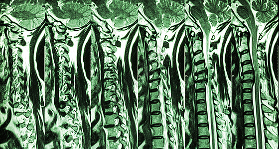 颈椎病伴椎间盘突出症 颈椎MRI 显示颈椎病伴椎间盘突出症压迫脊髓 脊髓病x光绳索柱子手术扫描放射科外科射线光盘诊断背景图片