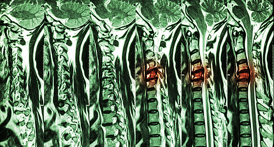 颈椎病伴椎间盘突出症 颈椎MRI 显示颈椎病伴椎间盘突出症压迫脊髓 脊髓病脊椎射线疼痛放射科病人核磁共振脊柱脖子药品诊断图片