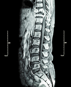 脊柱转移 癌扩散到胸椎 胸腰椎MRI 显示胸椎转移并压迫脊髓 脊髓病 矢状面绳索x光手术解剖学癌变压缩电影腰椎骨科科学背景图片