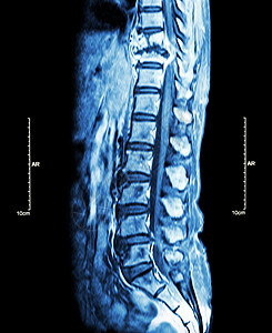 脊柱转移 癌扩散到胸椎 胸腰椎MRI 显示胸椎转移并压迫脊髓 脊髓病 矢状面骨干癌变骨骼外科腰椎脊椎诊断谐振解剖学放射科图片