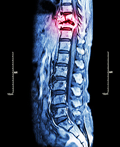 脊柱转移 癌扩散到胸椎 胸腰椎MRI 显示胸椎转移并压迫脊髓 脊髓病 矢状面胸部诊断手术放射科绳索扫描x光疼痛神经骨骼图片