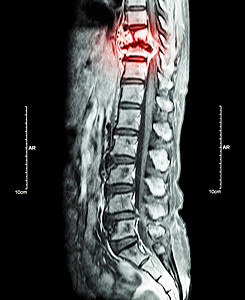 脊柱转移 癌扩散到胸椎 胸腰椎MRI 显示胸椎转移并压迫脊髓 脊髓病 矢状面椎骨柱子绳索疾病癌变胸部腰椎谐振科学x光图片