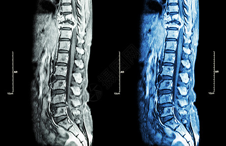 脊柱转移 癌扩散到胸椎 胸腰椎MRI 显示胸椎转移并压迫脊髓 脊髓病 矢状面手术x光扫描椎骨骨科骨骼科学谐振压缩解剖学背景图片