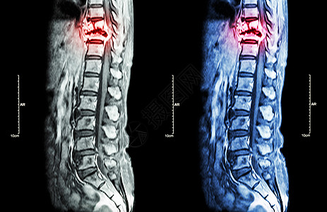 脊柱转移 癌扩散到胸椎 胸腰椎MRI 显示胸椎转移并压迫脊髓 脊髓病 矢状面骨骼腰椎癌变神经骨科解剖学柱子科学诊断扫描背景图片