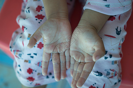 手足口病身体皮疹感染皮肤治疗孩子婴儿保健卫生湿疹背景图片