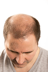 Alopecia 男人头发毛发失去理发移植皮肤治疗胡须活力疾病剪裁头皮护理发型图片