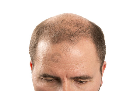 Alopecia 男人头发毛发失去理发活力成人损失剪裁护理梳子皮肤头皮治疗胡须图片