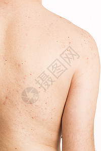 男性背部的肤色皮疹痘痘皮肤科卫生刺激青年疾病护理成人图片
