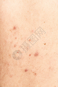 男性背部的治疗身体青年护理感染粉刺化妆品青春期肤色皮肤图片