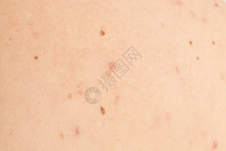 男性背部的感染疾病瑕疵化妆品皮肤科护理疙瘩青少年刺激痘痘图片