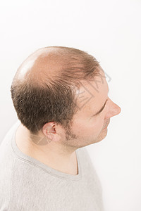 Alopecia 男人头发毛发失去理发活力秃顶皮肤移植疾病头皮剪裁发型男性成人图片