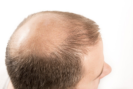 Alopecia 男人头发毛发失去理发护理皮肤疾病成人损失头皮梳子男性胡须科学背景图片