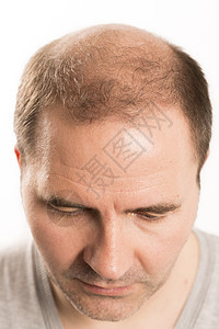 Alopecia 男人头发毛发失去理发成人头皮梳子治疗药品损失科学皮肤移植发型图片