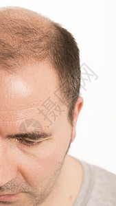 Alopecia 男人头发毛发失去理发剪裁移植治疗胡须皮肤男性成人科学疾病发型图片