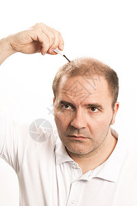 Alopecia 男人头发毛发失去理发药品头皮梳子秃顶移植治疗疾病护理皮肤科学图片