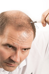 Alopecia 男人头发毛发失去理发头皮秃顶损失男性胡须皮肤疾病剪裁发型移植图片