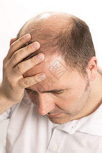 Alopecia 男人头发毛发失去理发梳子科学护理活力胡须疾病秃顶成人剪裁皮肤背景图片