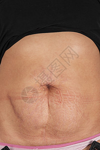 女性腹部 有伸展标志图片
