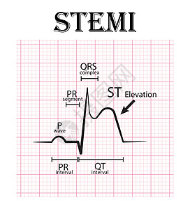 pr转场ST抬高心肌梗死心电图 STEMI心电图细节 P波 PR段 PR间期 QRS复合体 QT间期 ST抬高T波 急性冠脉综合征心绞痛插画