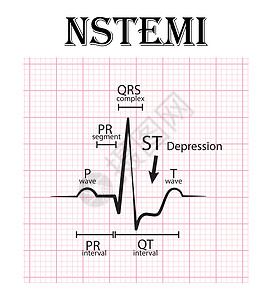 非 ST 段抬高心肌梗死心电图 NSTEMI 心电图细节图片