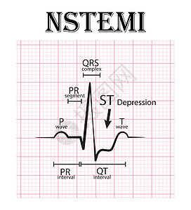 非 ST 段抬高心肌梗死心电图 NSTEMI 心电图细节背景图片