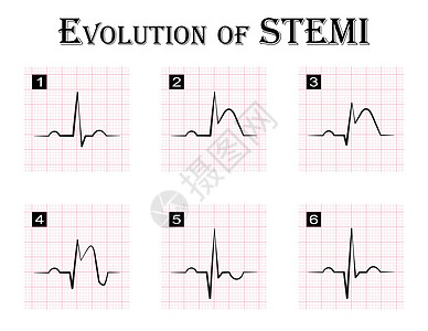 STEMI ST段抬高心肌梗死 急性冠脉综合征心绞痛的演变 逐步 心电图图片