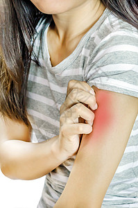 女性的刺痛女士过敏皮疹疙瘩皮炎疾病蚊子湿疹垃圾治疗图片