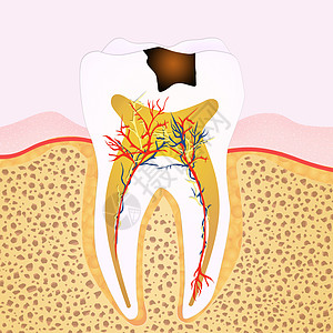 龋齿期药品搪瓷本质图表牙医插图脓肿学习衰变牙科背景图片