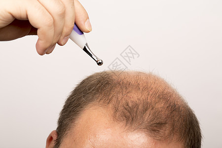 Alopecia 人毛发脱落治疗脱发男人男性皮肤护理发型药品活力损失图片