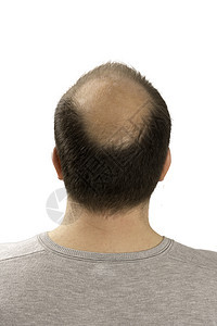 Alopecia 人毛发脱落梳子损失疾病移植治疗男性头皮发型脱发头发图片