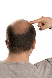 Alopecia 人毛发脱落移植活力疾病男性梳子护理皮肤药品脱发头发图片