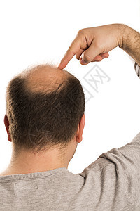 Alopecia 人毛发脱落头皮皮肤疾病治疗脱发活力头发药品秃顶剪裁图片