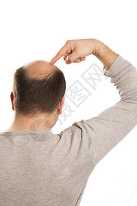 Alopecia 人毛发脱落发型损失治疗药品男性皮肤头皮护理男人胡须图片